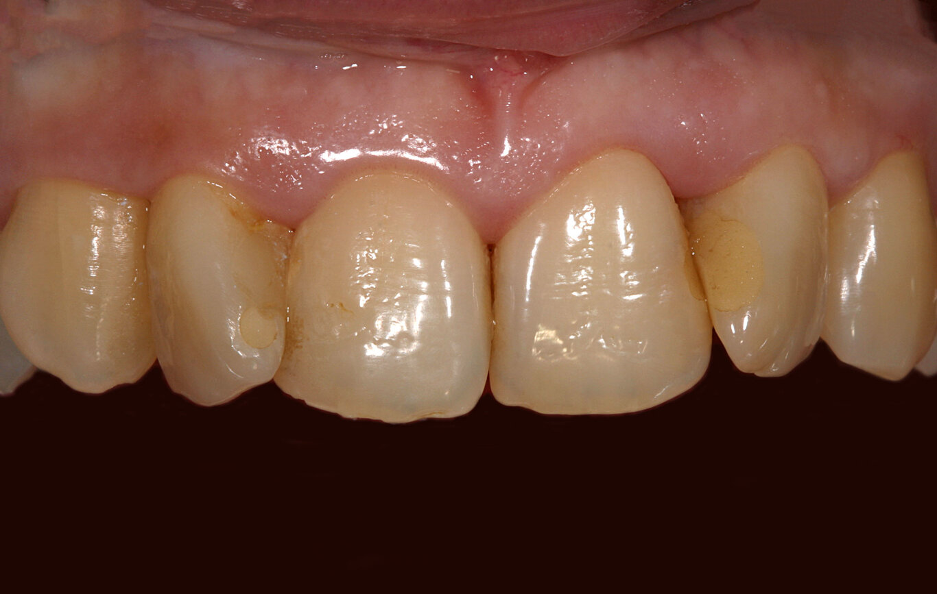 Ivoclar Prime Zirconia