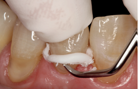 Ivoclar ZirCAD Cement
