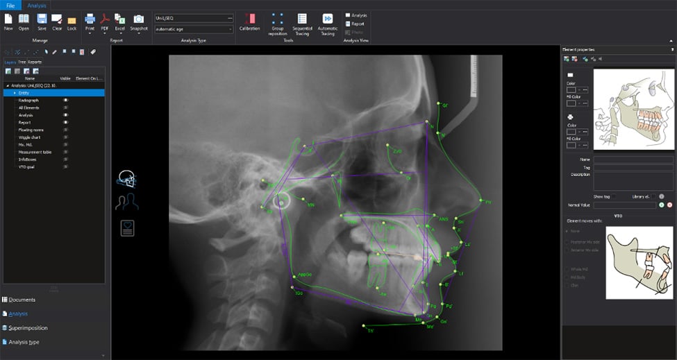 Planmeca Romexis Cephalometric Analysis