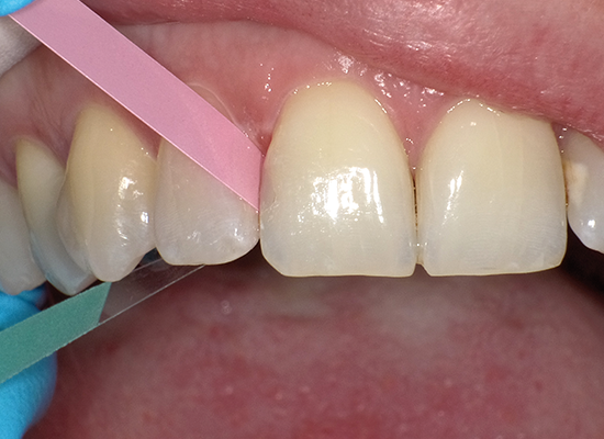 Shofu Super-Snap® Polystrips