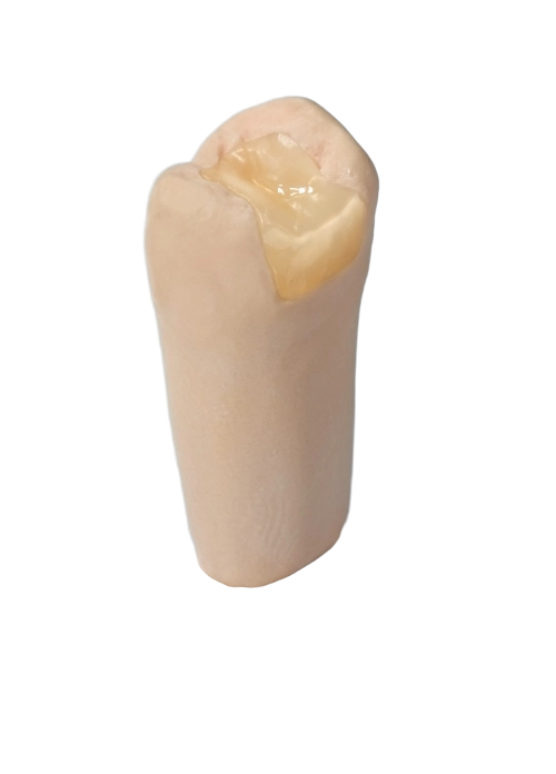 嵌体